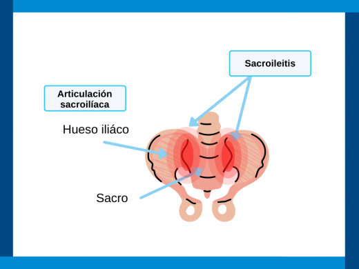 sacroiletis 