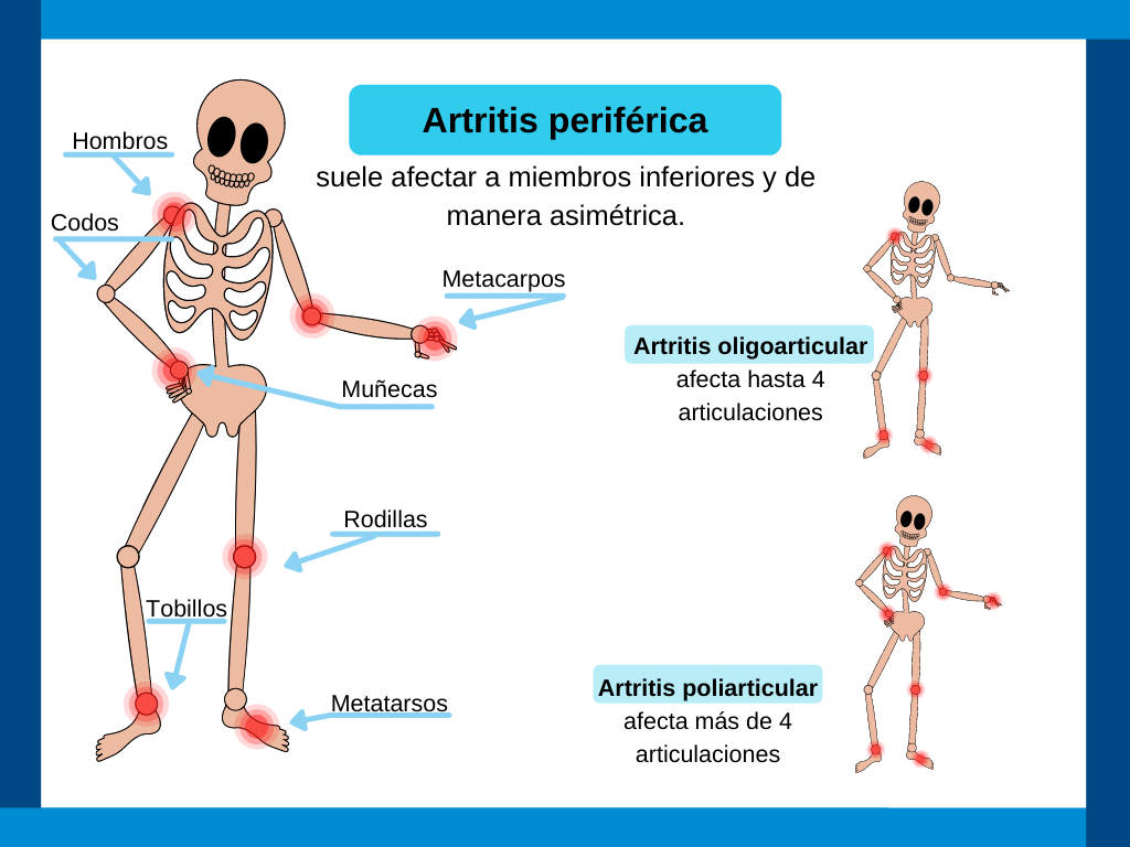 artritis periférica