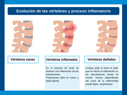 inflamacion vertebras espondilitis anquilosante