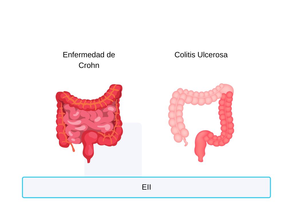 espondilitis-anquilosante-enfermedad-inflamatoria-intestinal