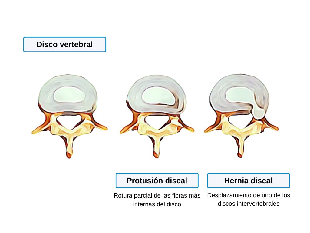 hernia discal en espondilitis